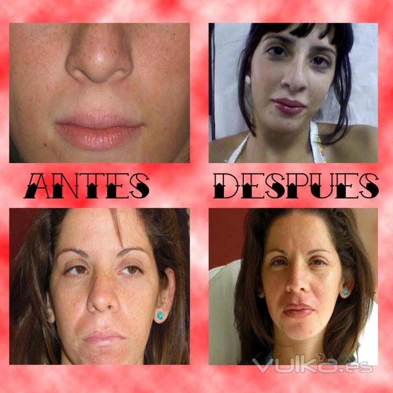 Micropigmentación de labios