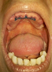 Implantes en forma de barra para sobre dentaduras