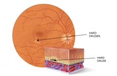 Esquema de formacion de drusas en retina
