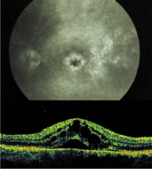 Edema macular cistoide
