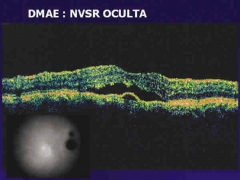 Membrana neovascular en dmae