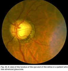 Glaucoma avanzado 65 % ceguera legal