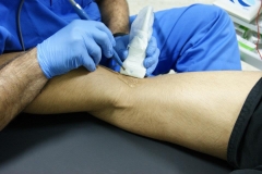 Epi en tendon de biceps femoral