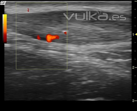 Tendinosis de aquiles con neovascularización