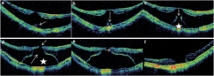 De retinosquisis a agujero: 2 meses