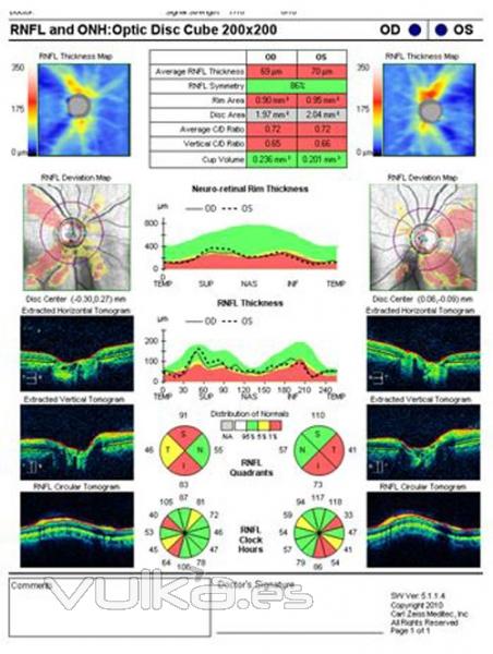 glaucoma en los límites