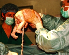 Extraccion de bebe en cesarea light