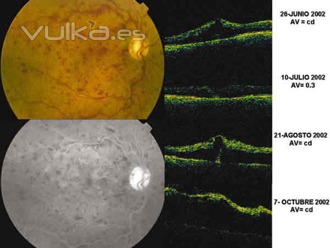 edema macular, donde no llega la AFG