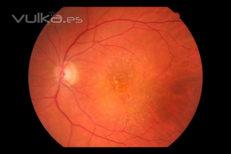 degener macular