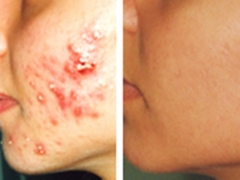 Tratamiento tca para pieles grasas con tendencia acneica