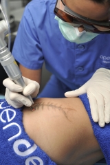 Eliminacion tatuaje con laser q-switched en clinica dermatologica openderma, murcia