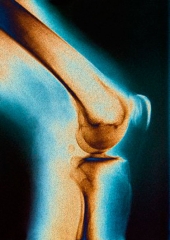 Tratamientos para las lesiones osteoarticulares