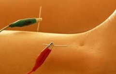 Electro-acupuntura para adelgazar