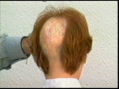 Protesis capilar a medida para todo tipo de alopecia