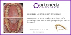 Ortodoncia invisible / incognito