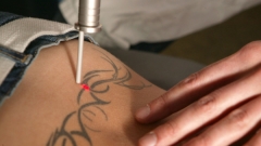 Eliminacion de tatuajes tenerife - tattoo-off - foto 30