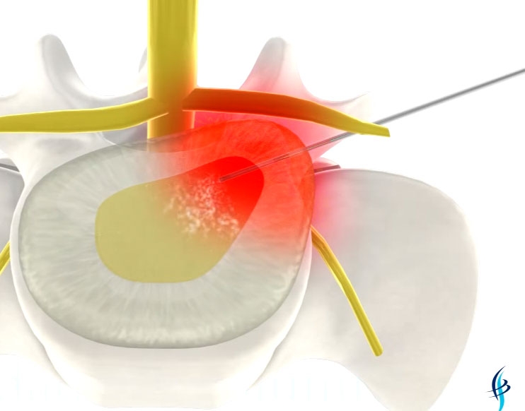 Técnica de eliminación de hernias discales sin cirugía