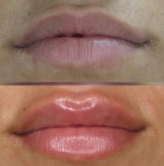 Remodelacion labios