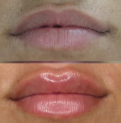 Remodelación labios