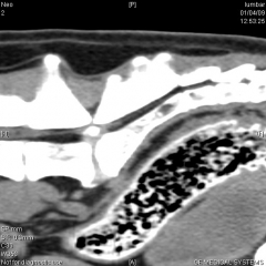 Imagen de tac: hernia discal en l/s