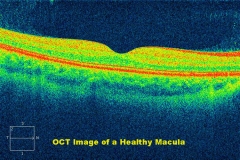 Oct de alta definicion de la macula (retina)