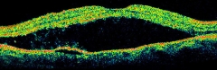 Desprendimiento de retina (imagen de oct))
