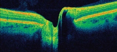 Estudio de nervio optico (imagen de oct)