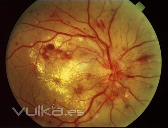 RETINOPATÍA HIPERTENSIVA (EXAMEN DE FONDO DE OJO)