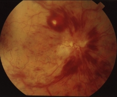 Trombosis de la vena central de la retina (fondo de ojo)