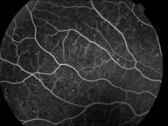 Microaneurismas retinianos (angiografia)