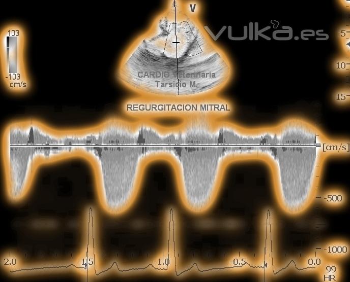 ECOCARDIOGRAFÍA DOPPLER CONTINUO REGURGITACIÓN MITRAL , SINCRONIZADO ECG