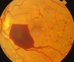 Hemorragia pre-retiniana en retinopatia diabetica