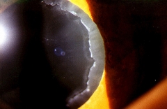 Pseudoexfoliacion del cristalino ocular