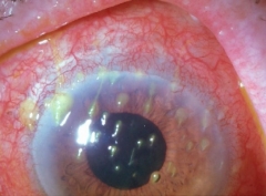 Queratitis filamentosa en ojo seco