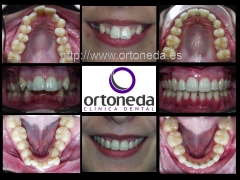 Ortodoncia estetica adultos