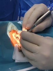 Doctor miguel march durante una extraccion de catarata con facoemulsificador infiniti ozil ip