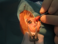 Doctor miguel march extrayendo una catarata con anestesia topica (gotas)